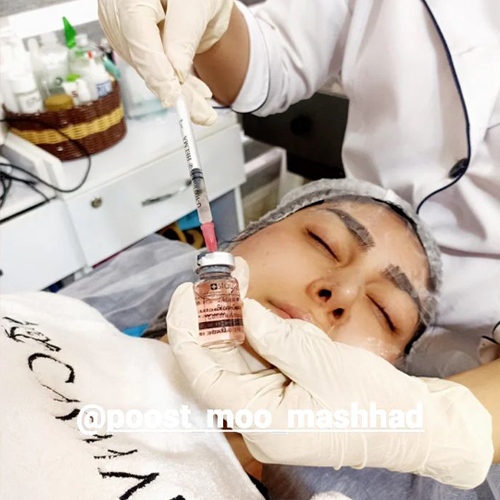 ویدئو نمونه مزونیدلینگ